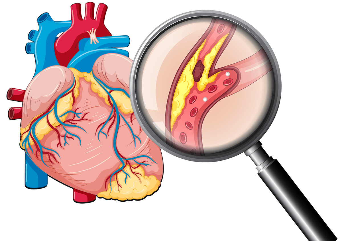 Hipercolesterolemia